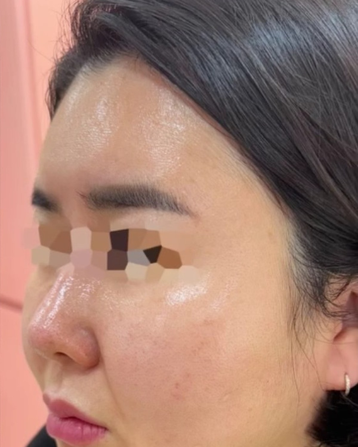 Case 03 after treatment