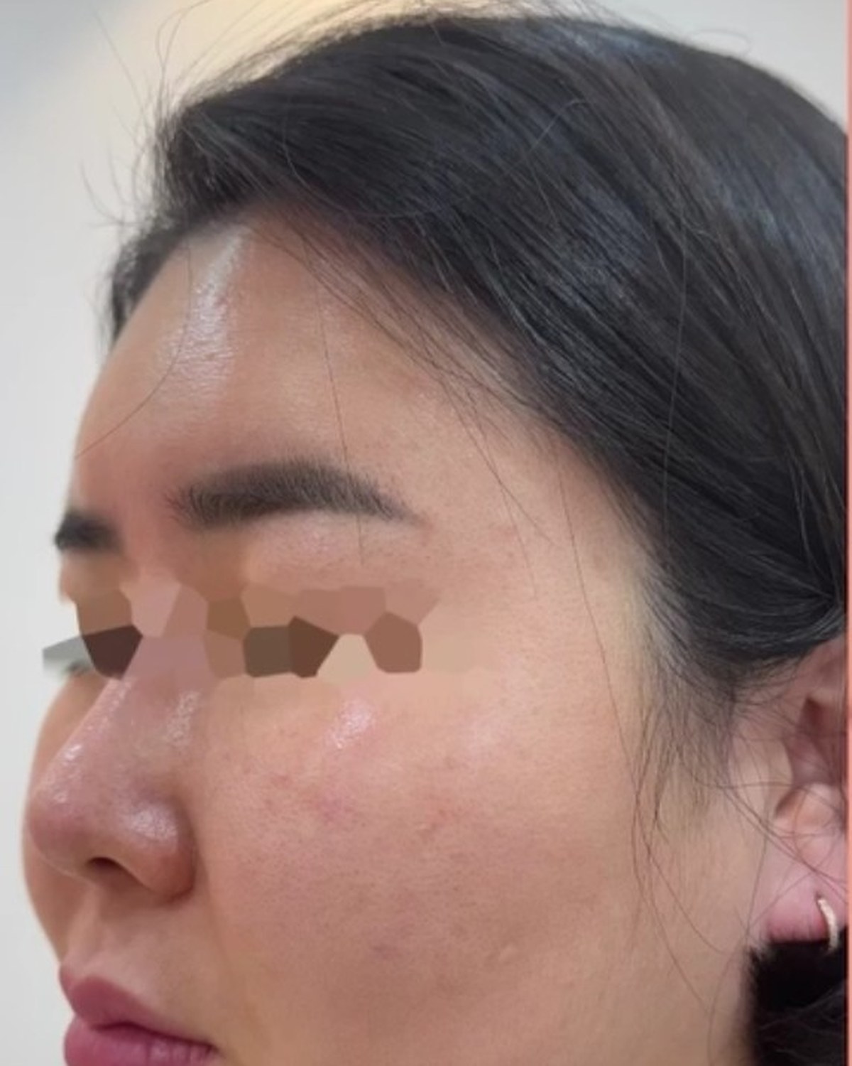 Case 03 before treatment