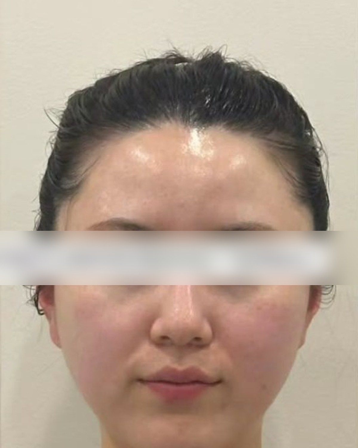 Case 04 after treatment