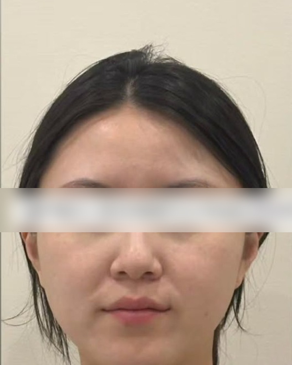 Case 04 before treatment